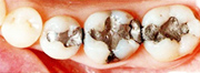 銀歯治療