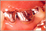 銀歯治療